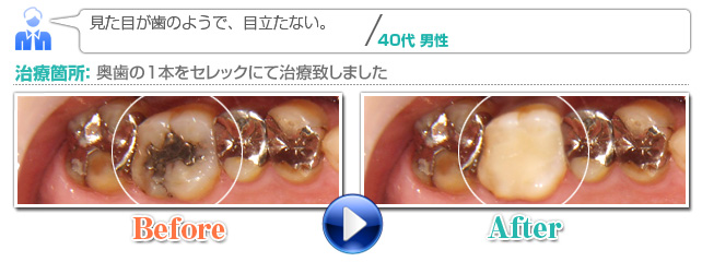 セレック BeforeAfter01