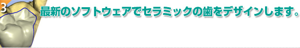 最新のソフトウェアでセラミックの歯をデザインします。