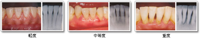 軽度・中程度・重度